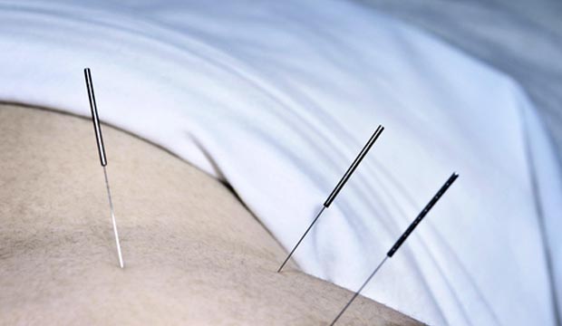 L'acupuncture pour combattre le stress