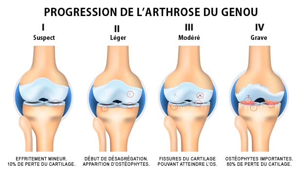 D'où provient l'arthrose?