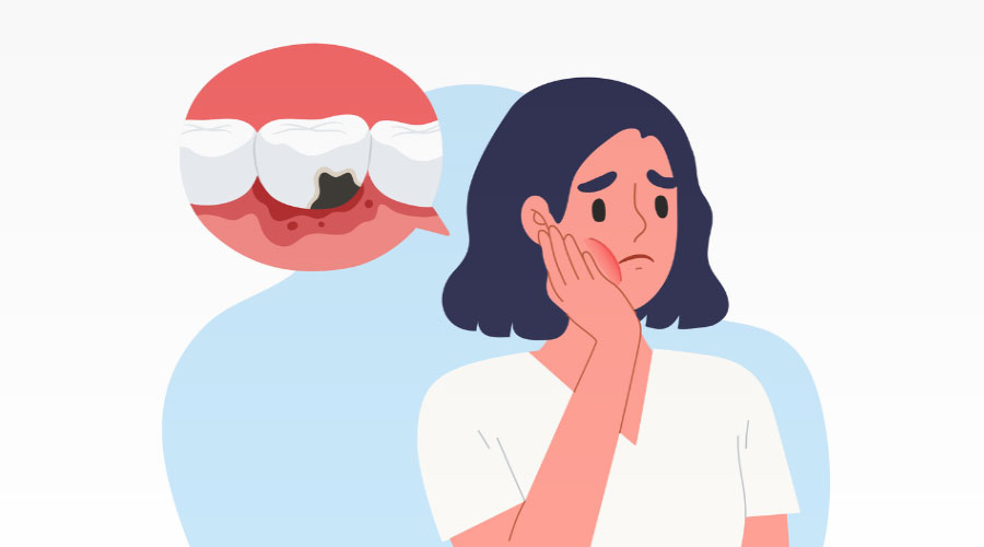 Comment se forment les caries?