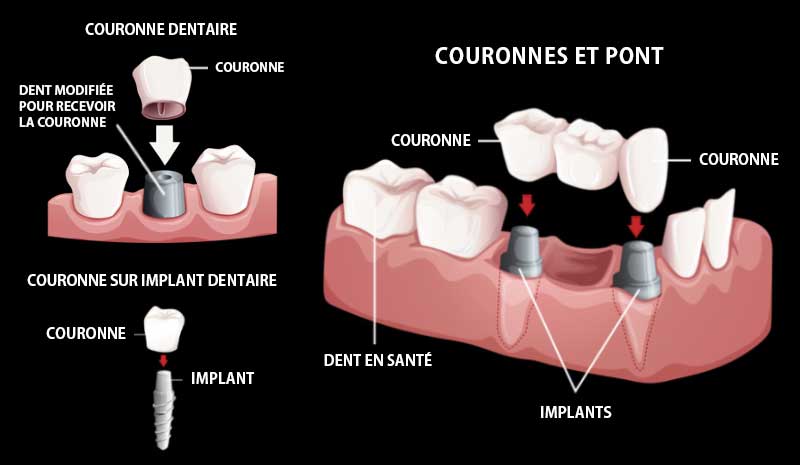 La couronne dentaire