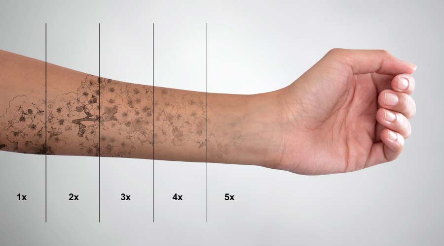 Détatouage : peut-on effacer un tatouage indésirable?