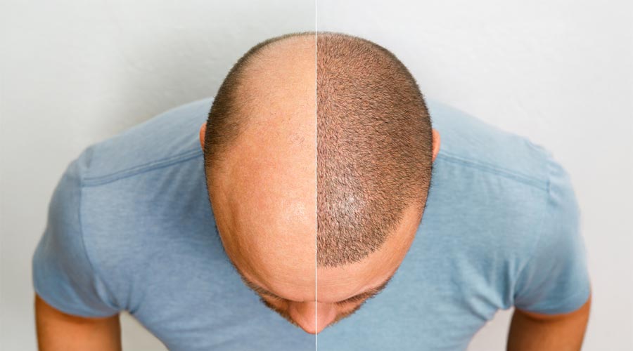 Greffe de cheveux : une solution miracle contre la calvitie?