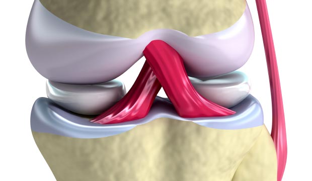 Rupture du ligament croisé antérieur (LCA)