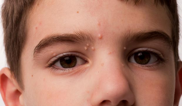 Le molluscum contagiosum