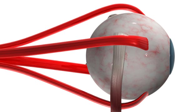 Correction du strabisme par la chirurgie