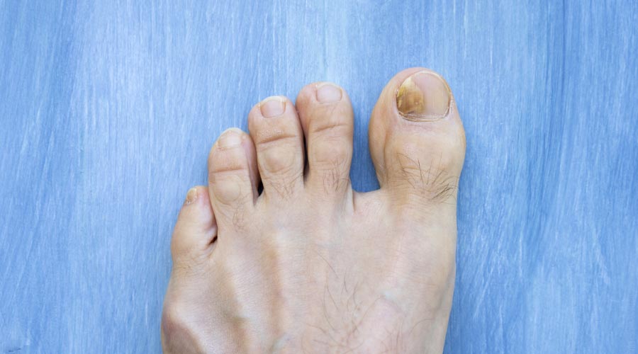 Mycose des ongles : causes, symptômes, traitements et prévention