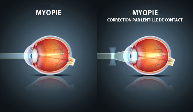 La myopie