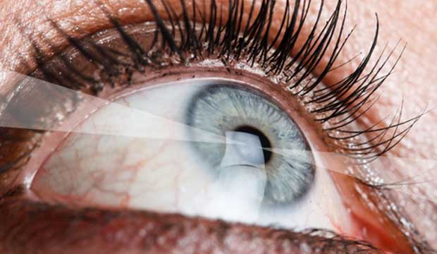 Correction de la vue au laser