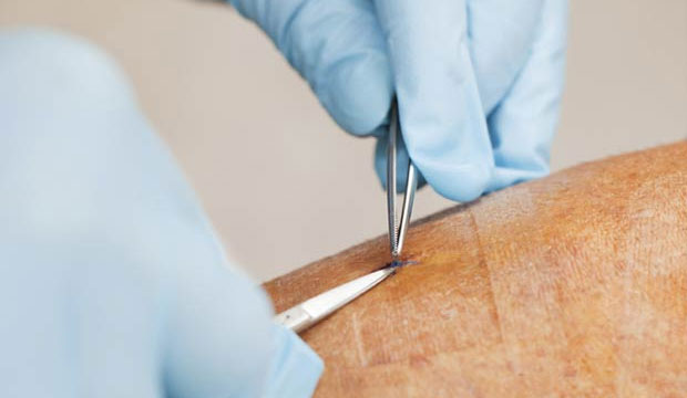 Trouver un phlébologue avec le répertoire Index Santé