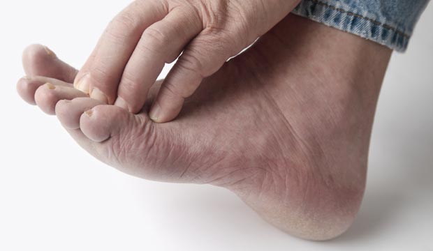 Le pied d'athlète