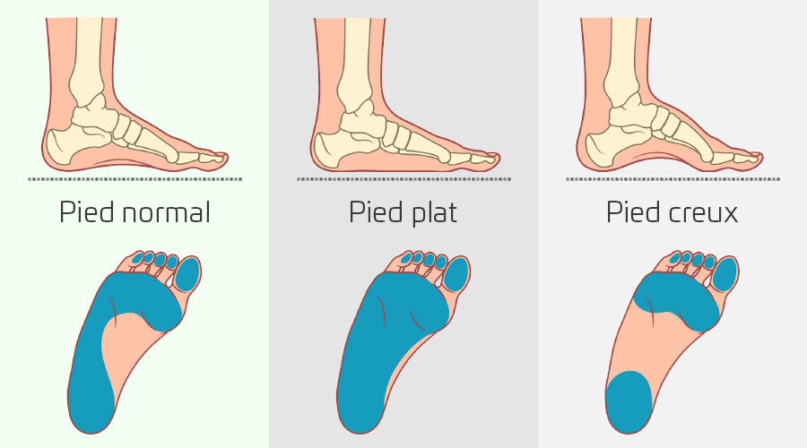 Avez-vous les pieds creux?