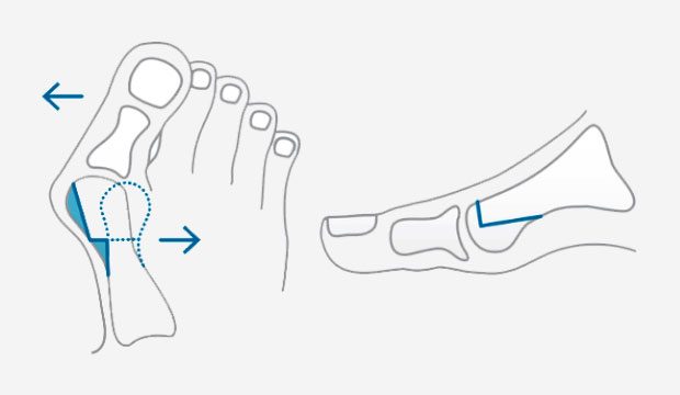 Hallux valgus (oignon au pied)