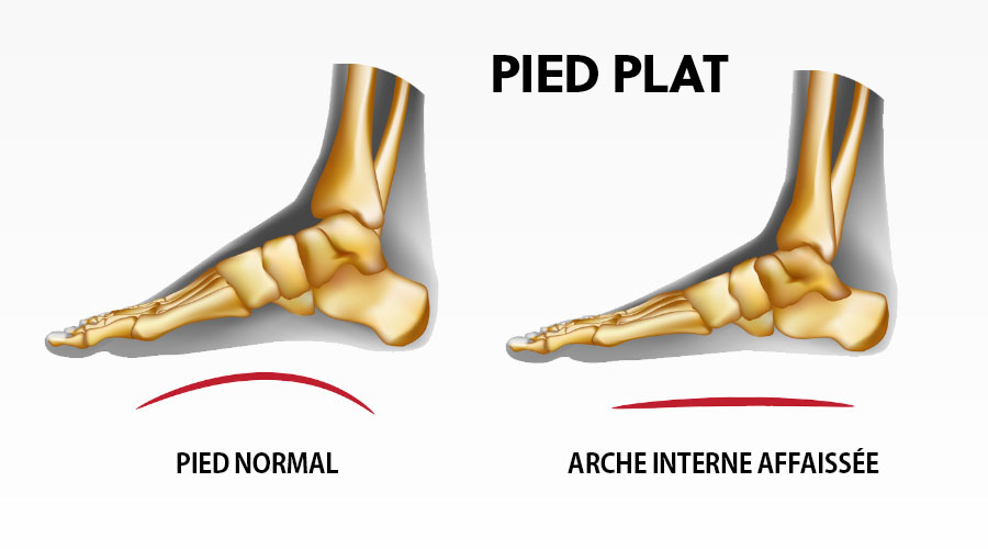 Pieds plats : causes, symptômes et traitements
