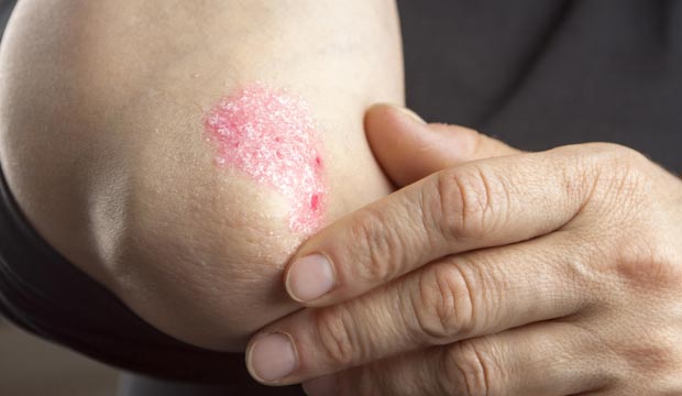 Le psoriasis