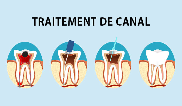 Qu'est-ce qu'un traitement de canal?