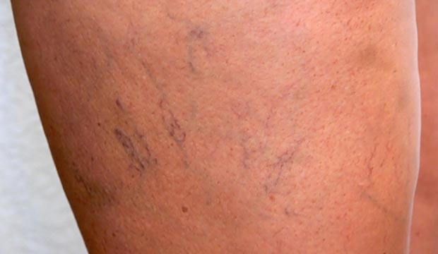 Détection et prévention des varices