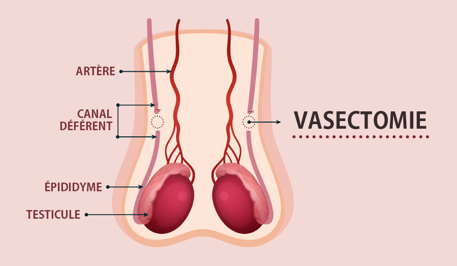 La vasectomie