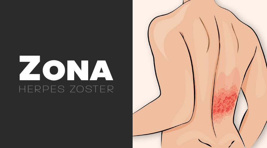 Le zona (herpès zoster)