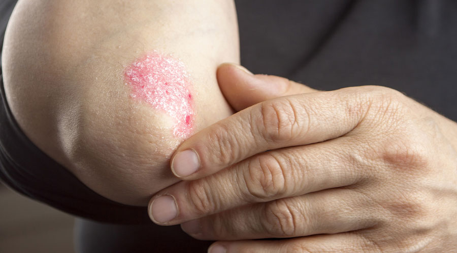 Psoriasis
