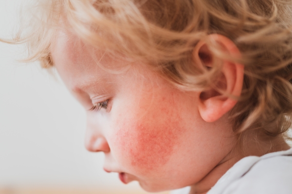 Lors du mois de la sensibilisation, la Société canadienne de l'eczéma est prête pour un changement!