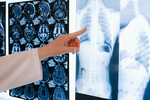 Nouveau rapport sur l'hypertension pulmonaire révèle des lacunes critiques dans le diagnostic et le traitement au Canada