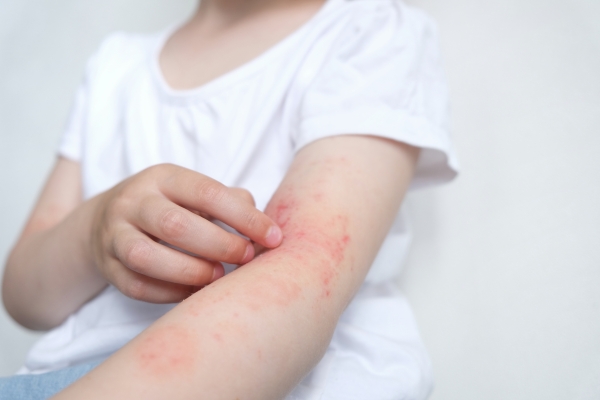 Un sondage national révèle les conséquences cachées de la dermatite atopique et l’urgence d’élargir l’accès aux traitements