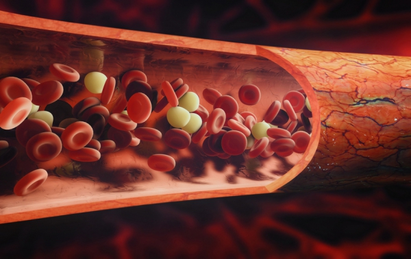 Un traitement précoce avec la colchicine débutant en milieu hospitalier réduit de 48% les risques de futurs problèmes cardiovasculaires