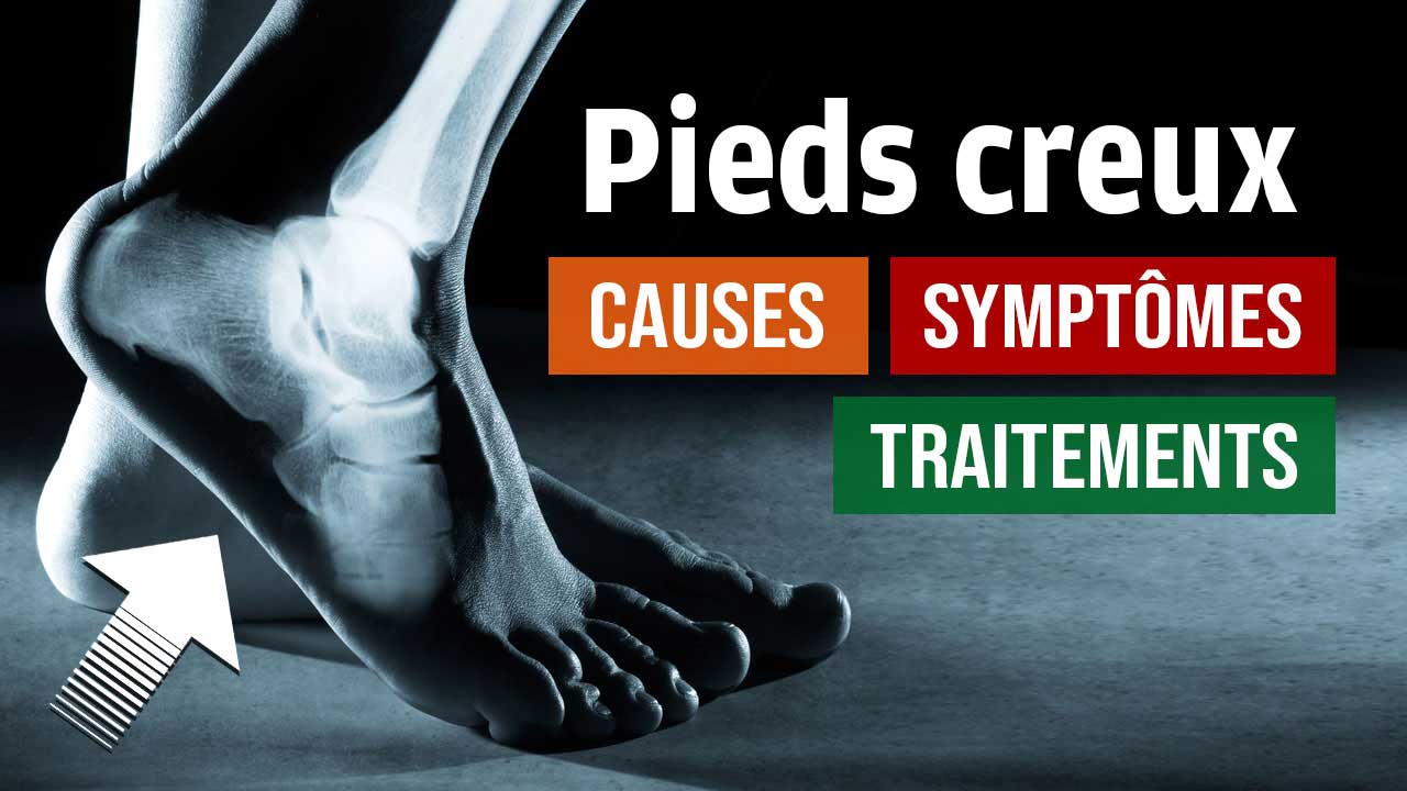Pieds creux : causes, symptômes et traitements